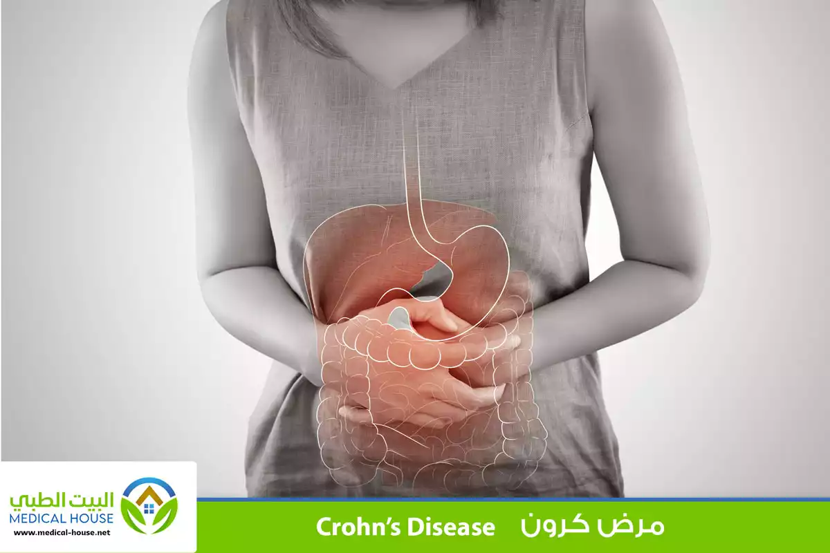 مرض كرون