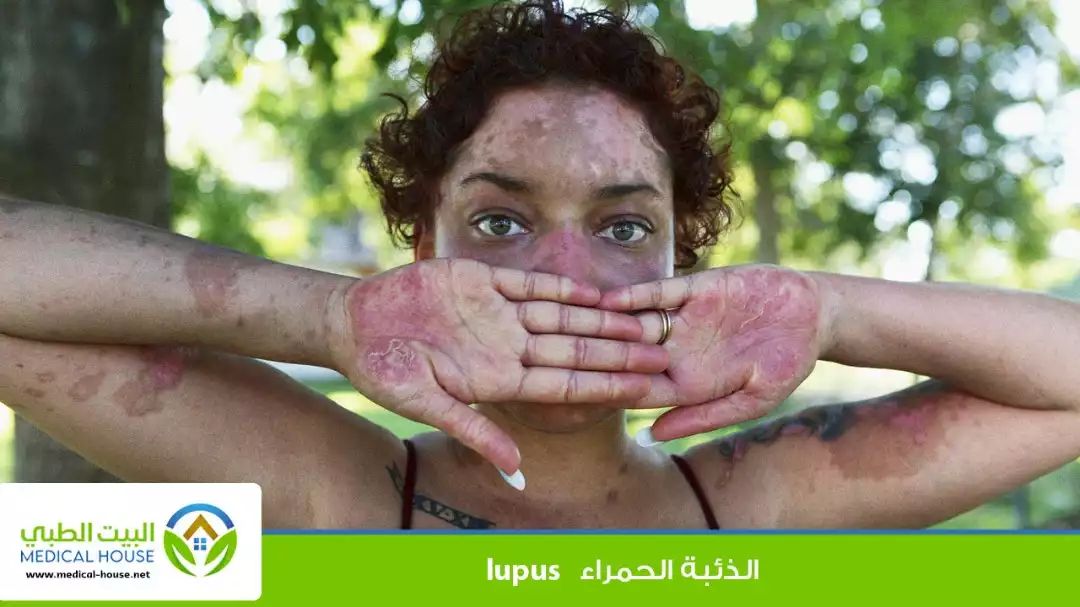 الذئبة وكل ما تحتاج لمعرفته عن هذا المرض