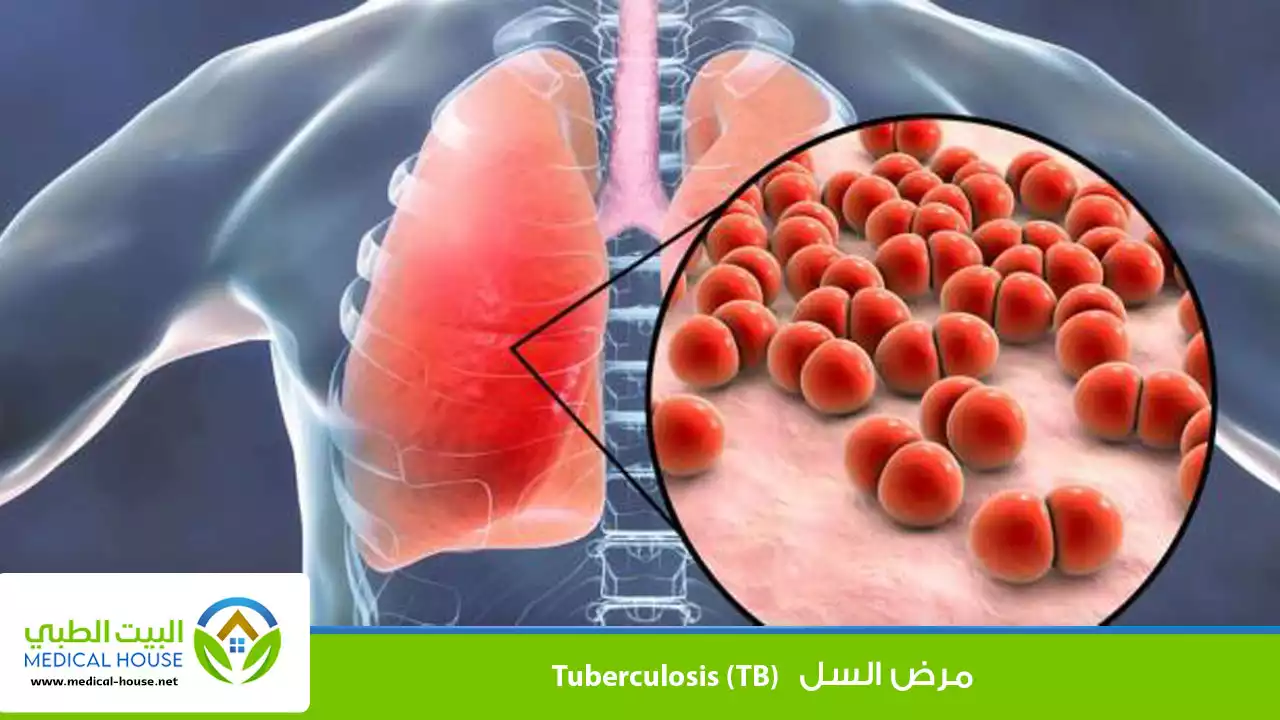 كل ما تحتاج معرفته عن مرض السل