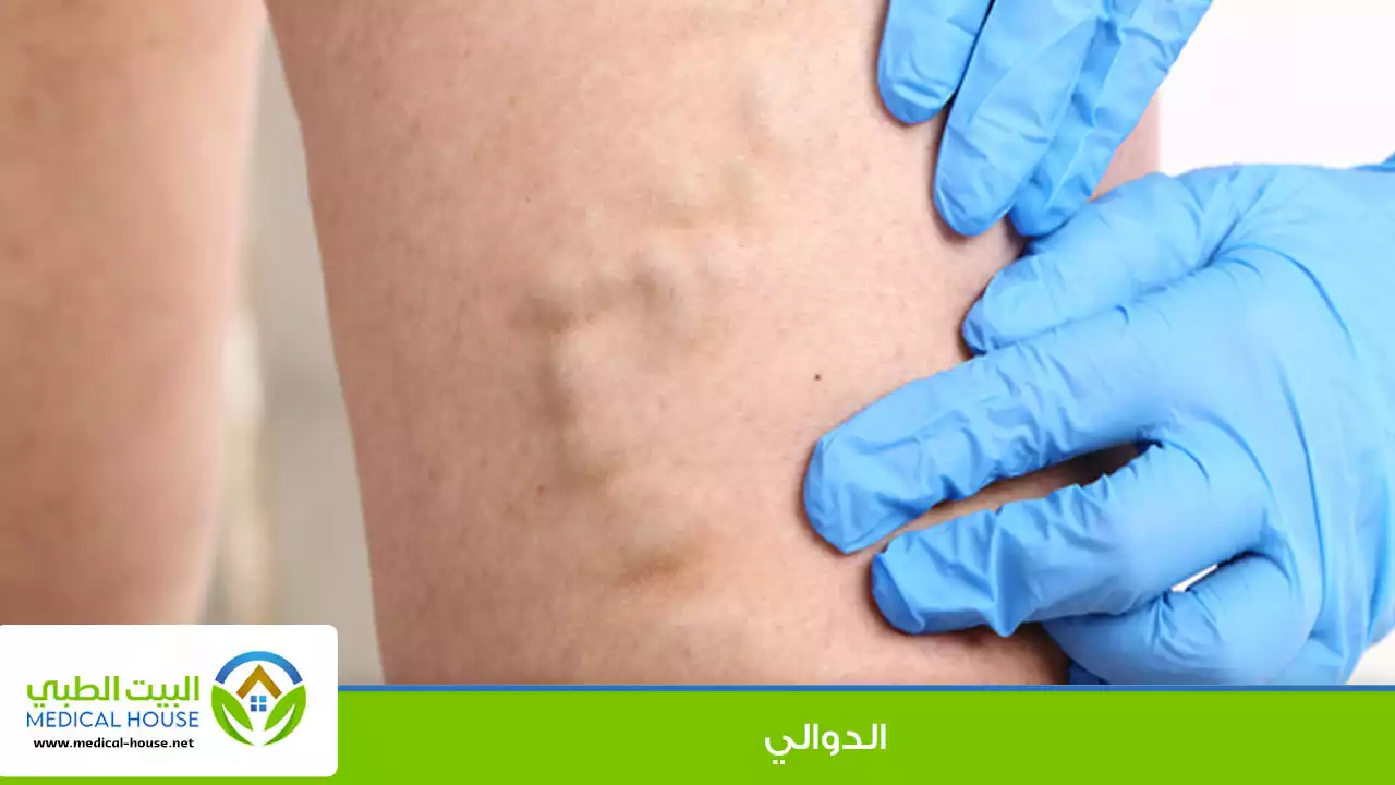 الدوالي الوريدية ـ الاسباب ، الوقاية وطرق العلاج