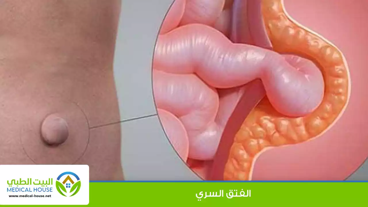 الفتق السري ـ الاسباب وطرق العلاج