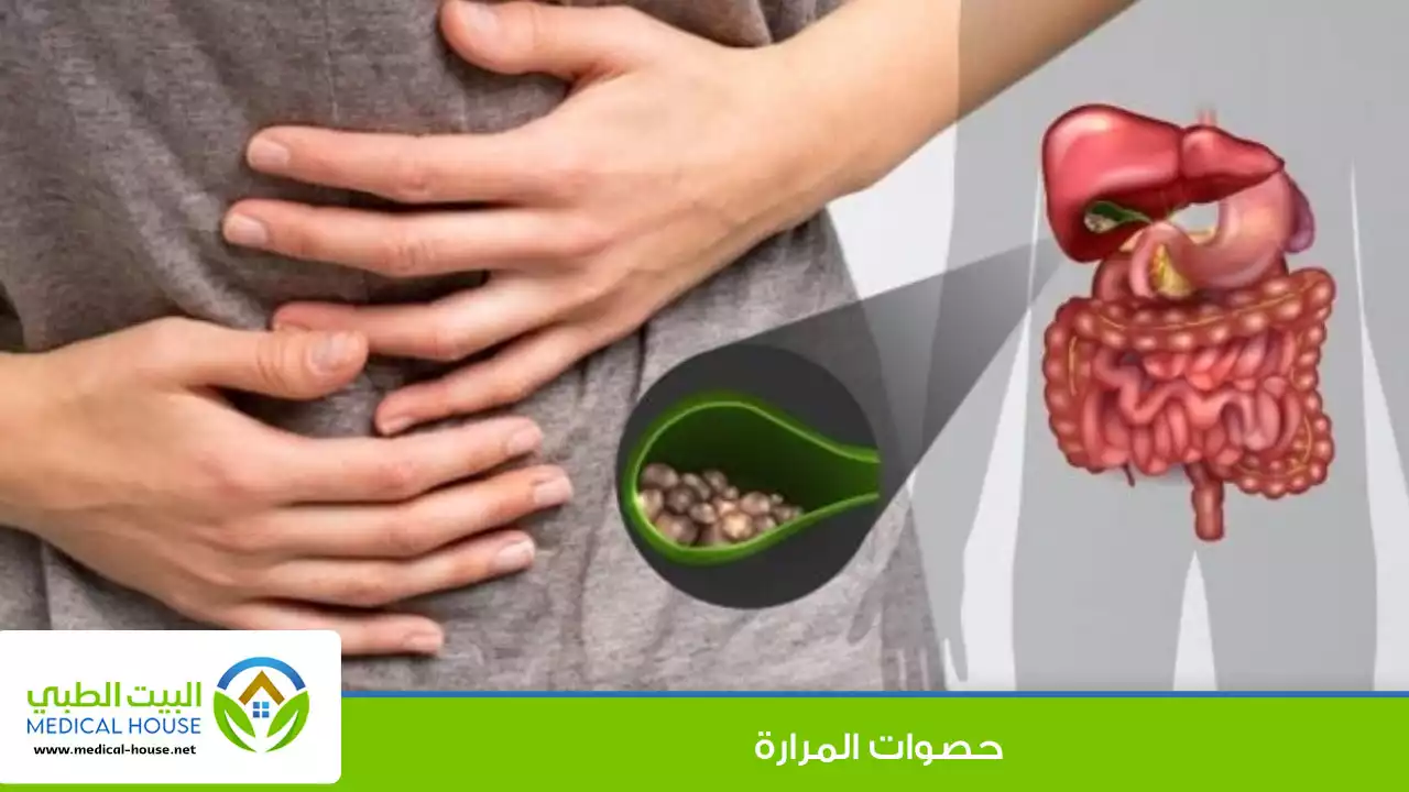 حصوات المرارة