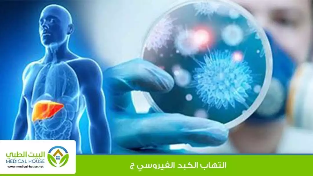 التهاب الكبد الفيروسي ج