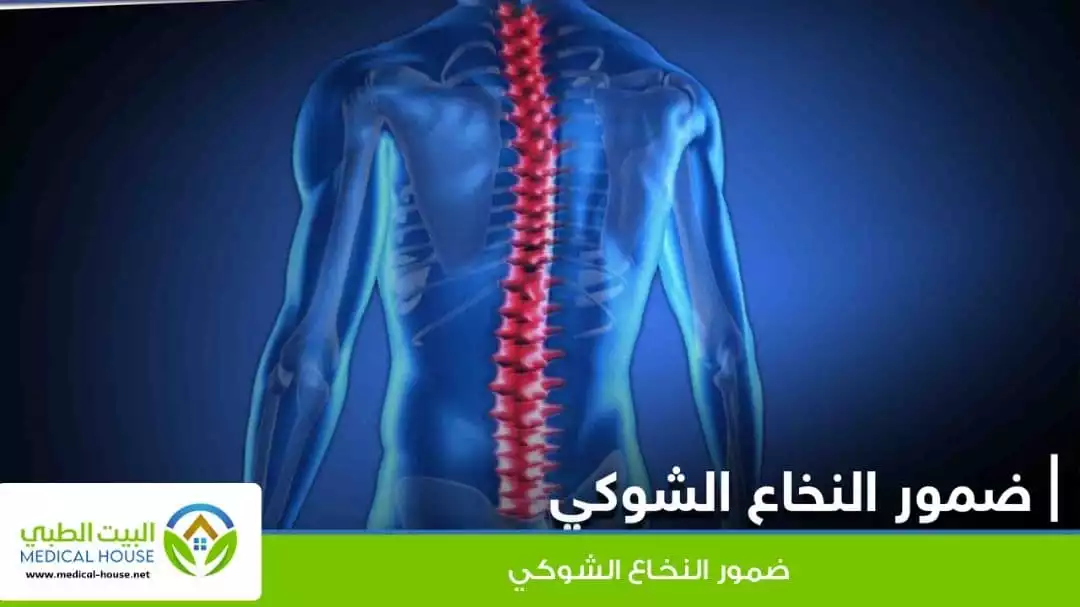 ضمور النخاع الشوكي