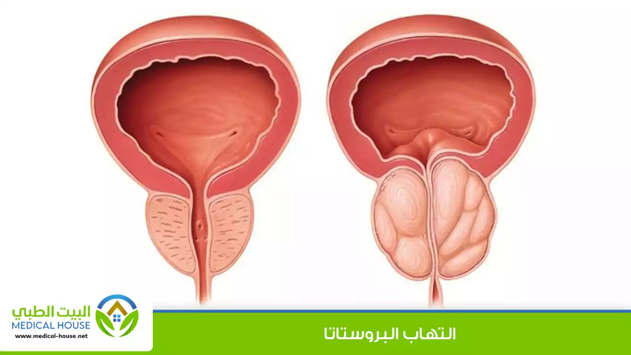 التهاب البروستاتا