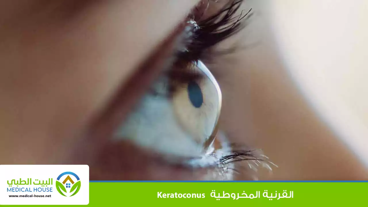 القرنية المخروطية