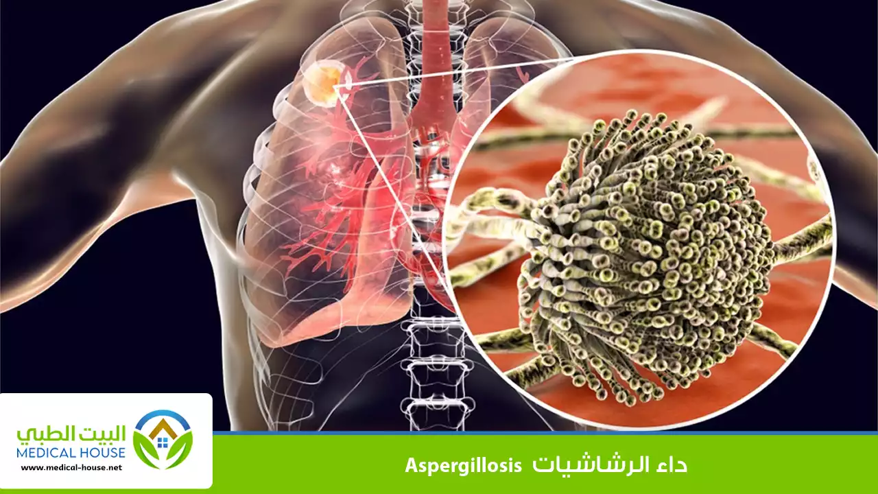 داء الرشاشيات