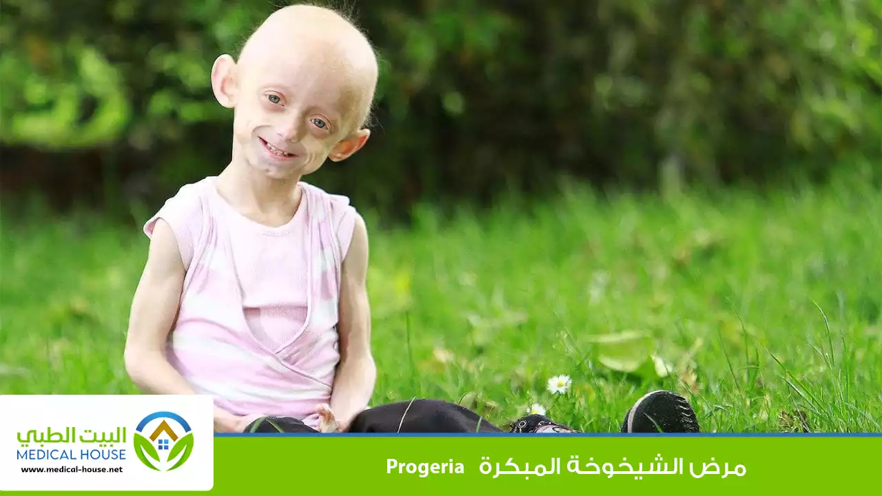 مرض الشيخوخة المبكرة أو بروجيريا