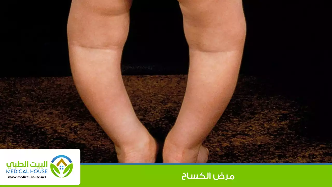 مرض الكساح