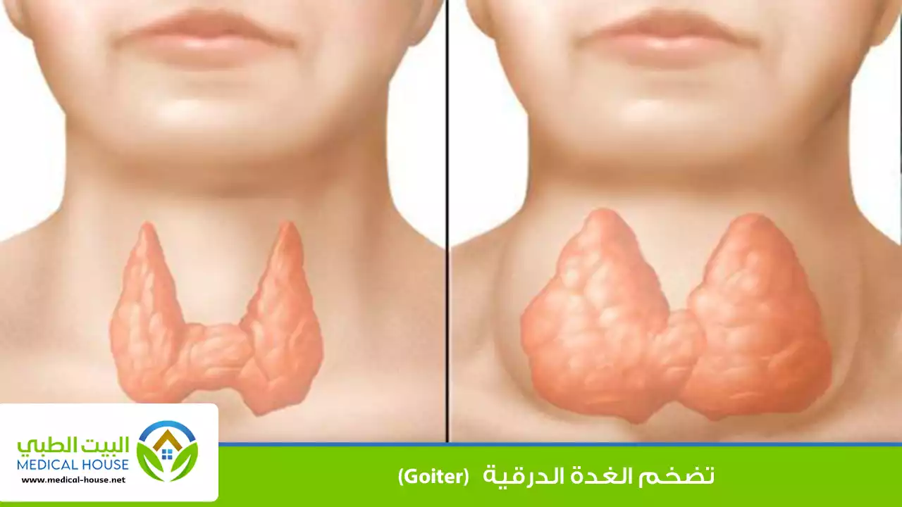تضخم الغدة الدرقية