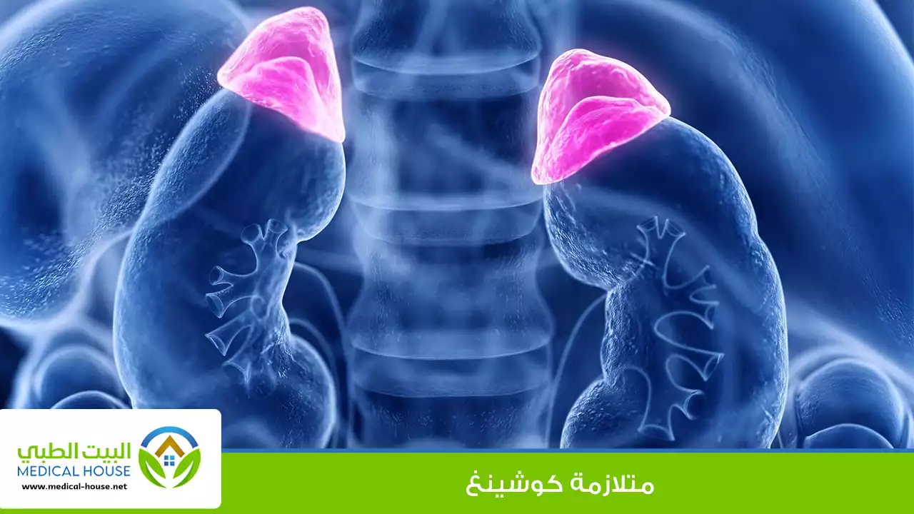 متلازمة كوشينغ