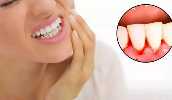نزيف اللثة اثناء غسل الاسنان