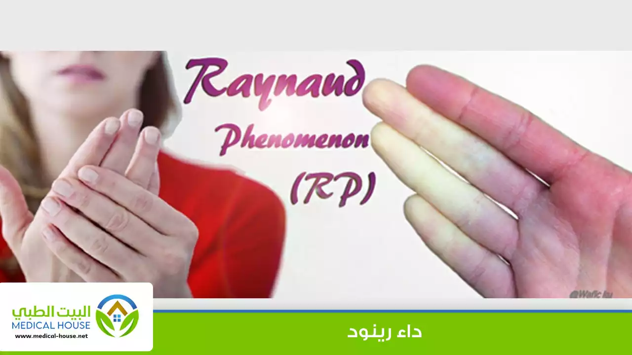 مرض رينود الأسباب والعلاج