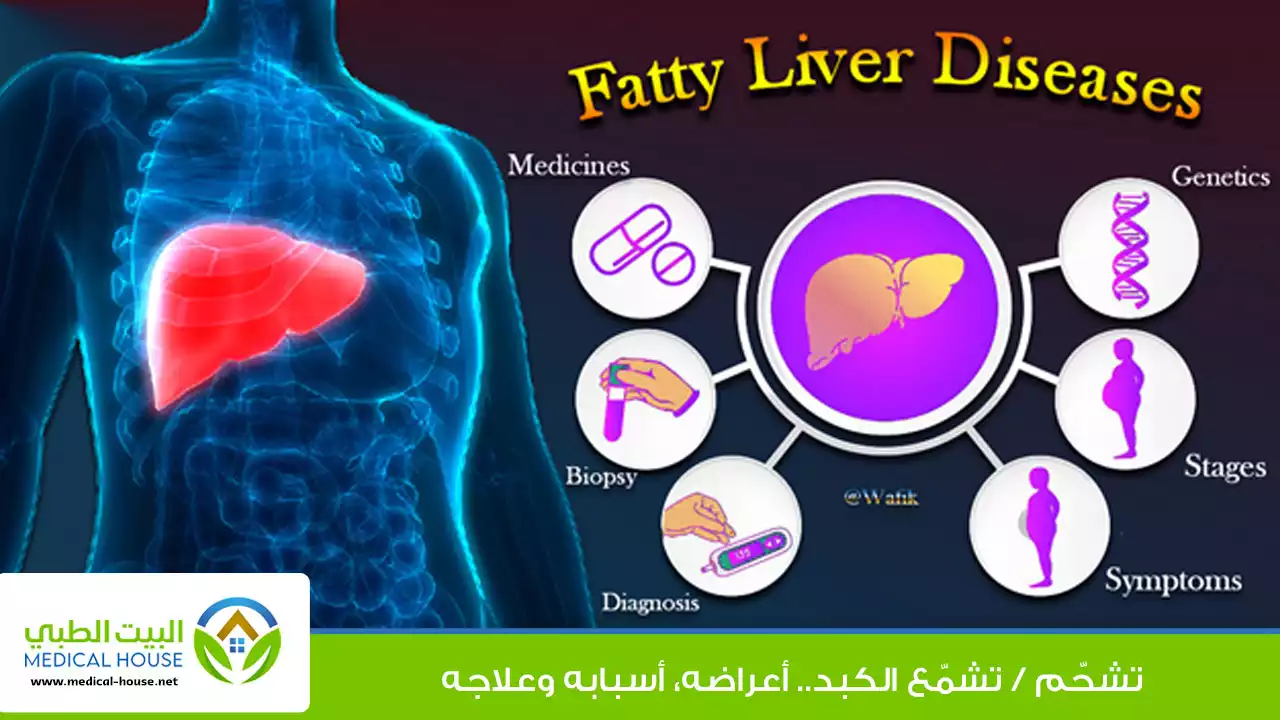 تشحم الكبد Fatty Liver