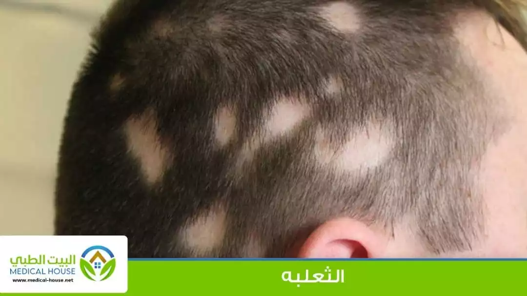 الثعلبة