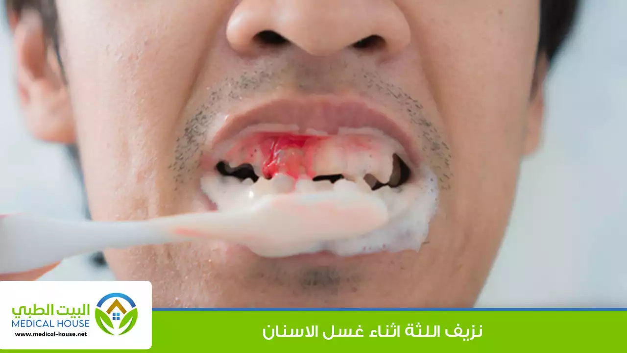 نزيف اللثة اثناء غسل الاسنان