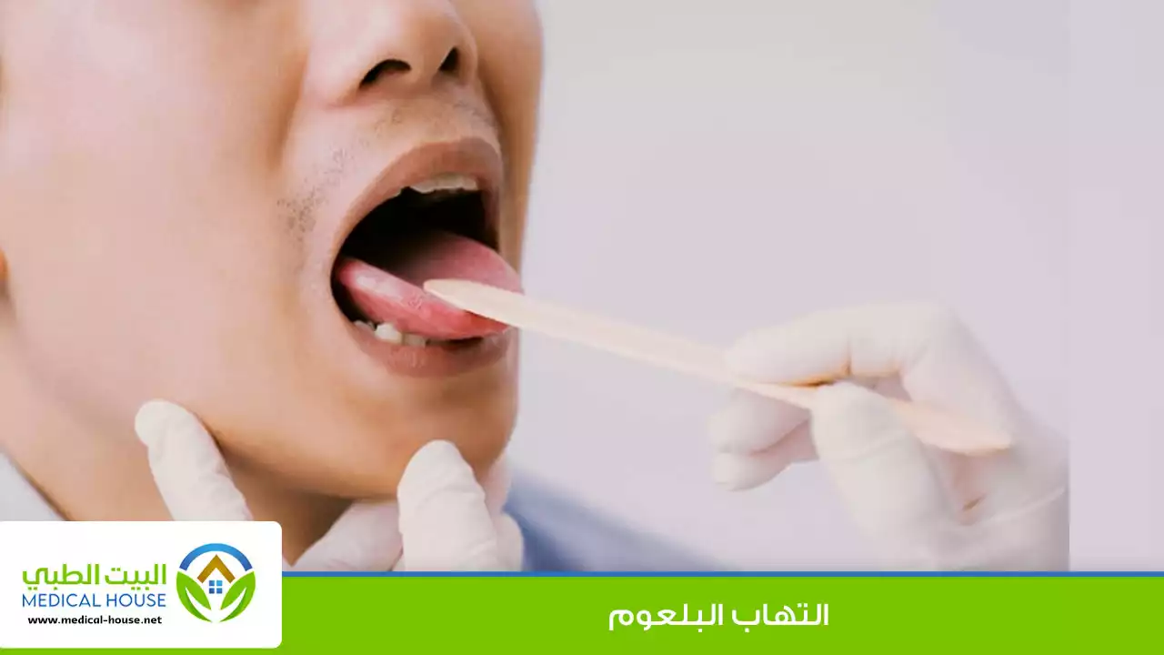 التهاب البلعوم