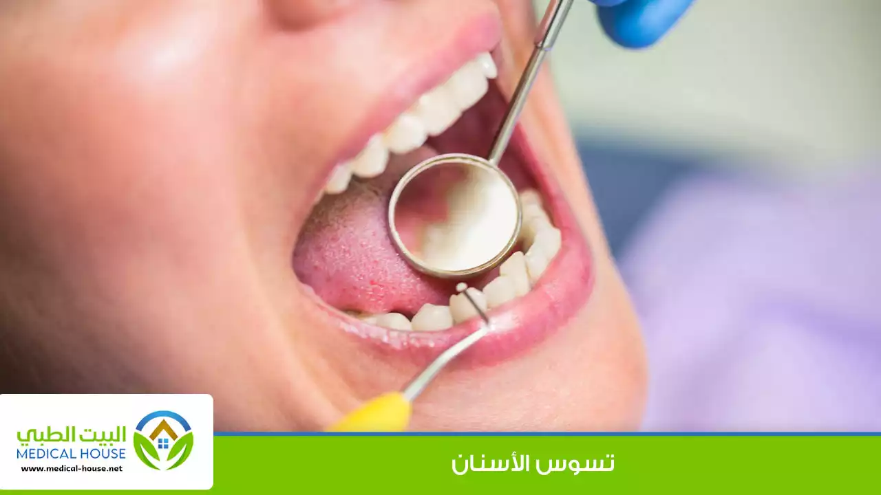 تسوس الأسنان ـ المراحل و الاعراض والوقاية