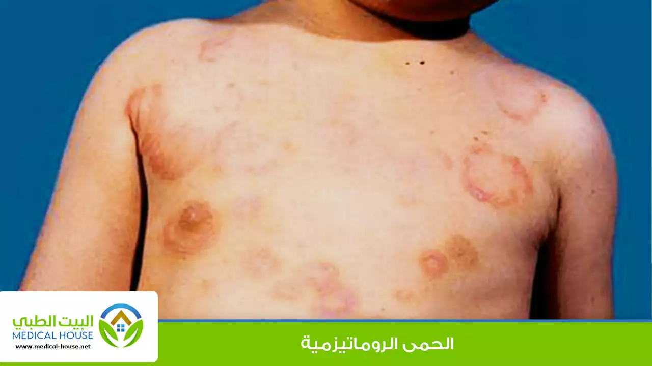الحمى الروماتيزمية الاعراض وطرق العلاج