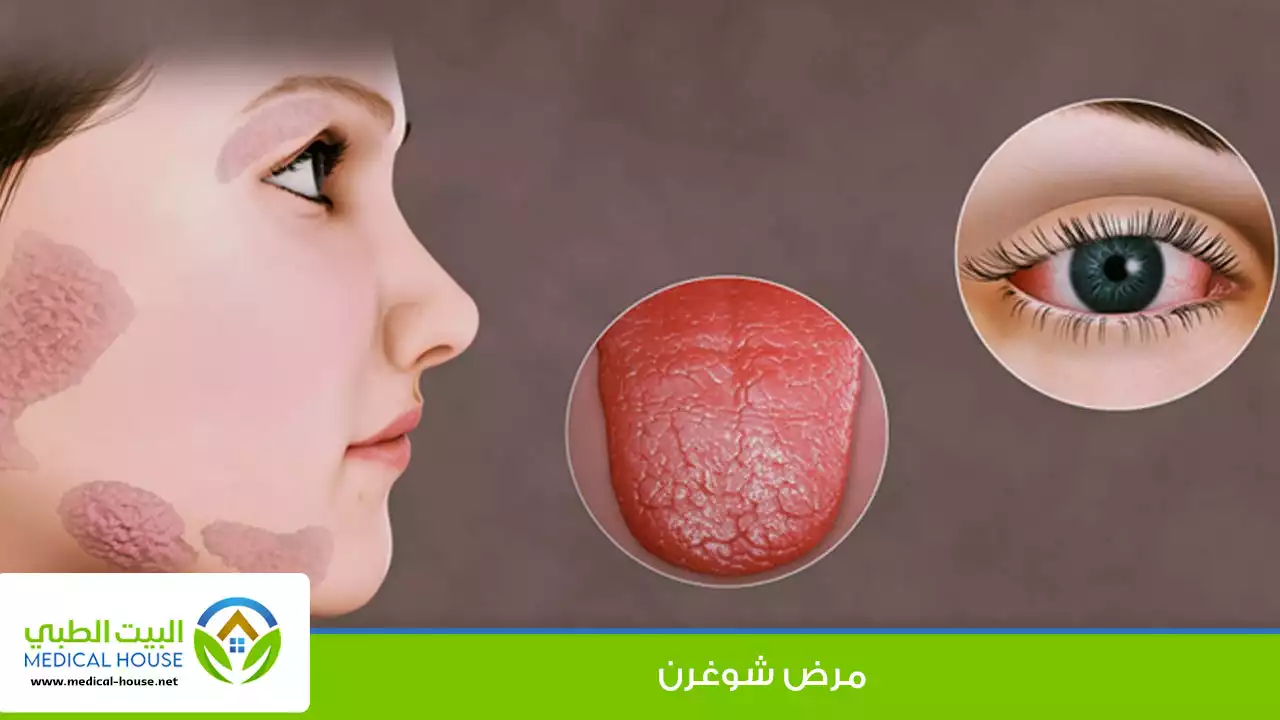 متلازمة شوغرن الاعراض والاسباب وطرق العلاج