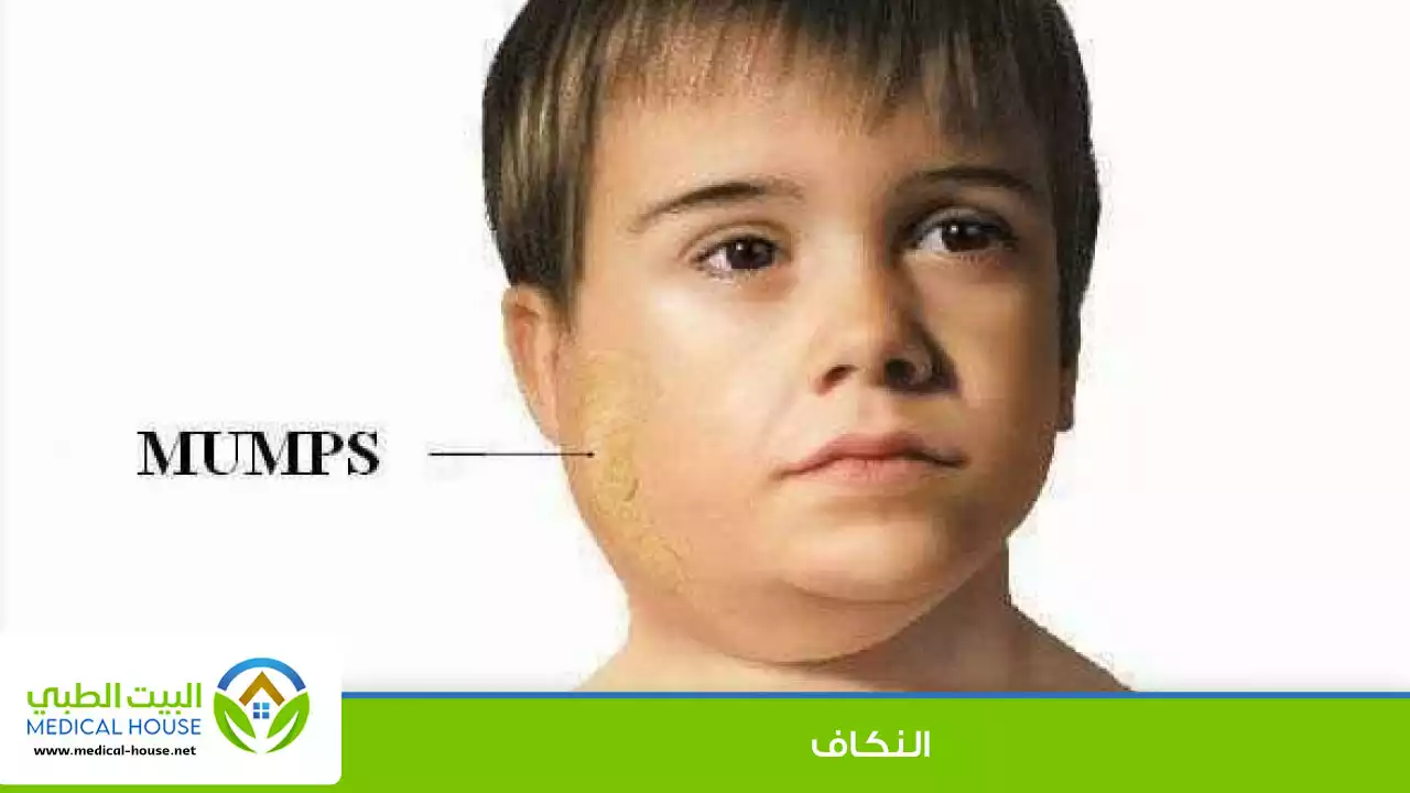 التهاب الغدة النكافية
