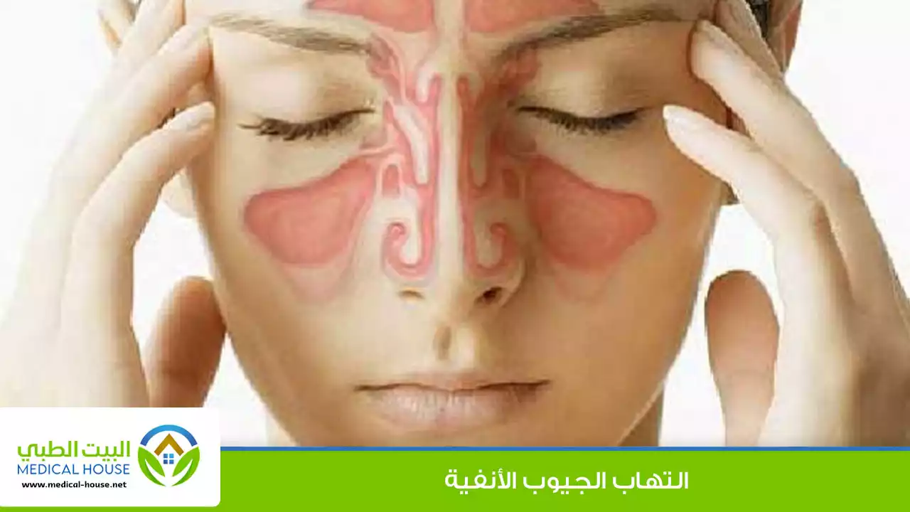 التهاب الجيوب الأنفية