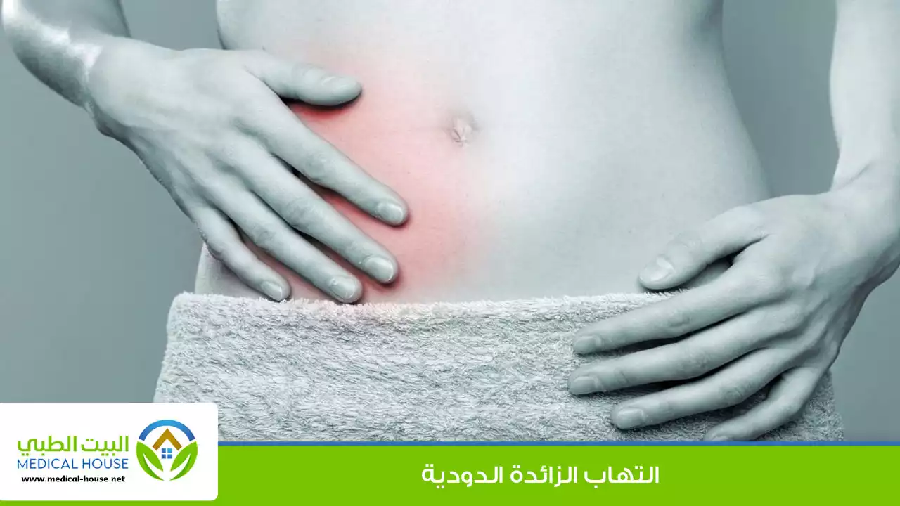 التهاب الزائدة الدودية