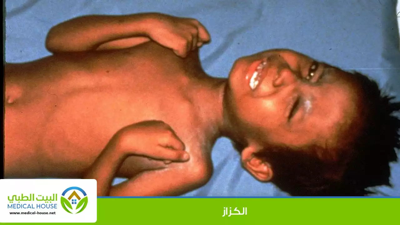 الكزاز ـ التيتانوس Tetanus