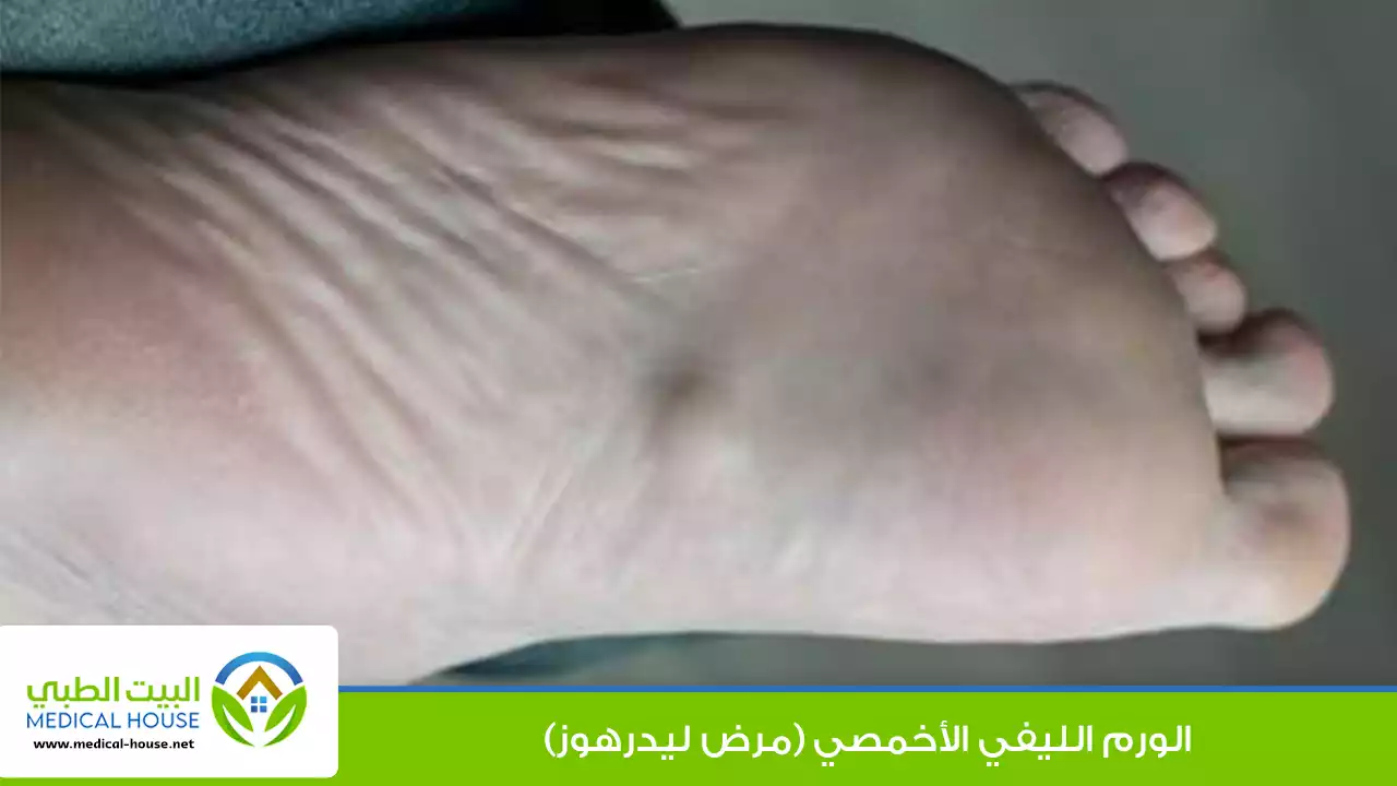الورم الليفي الأخمصي