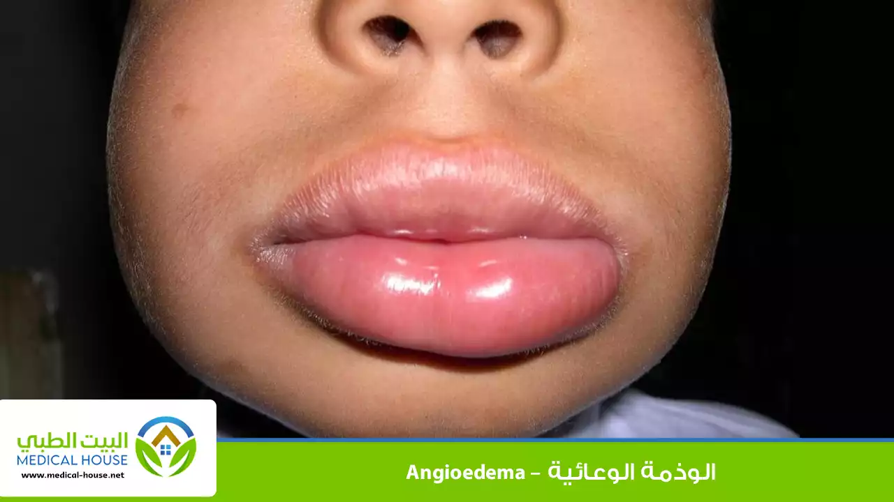 الوذمة الوعائية