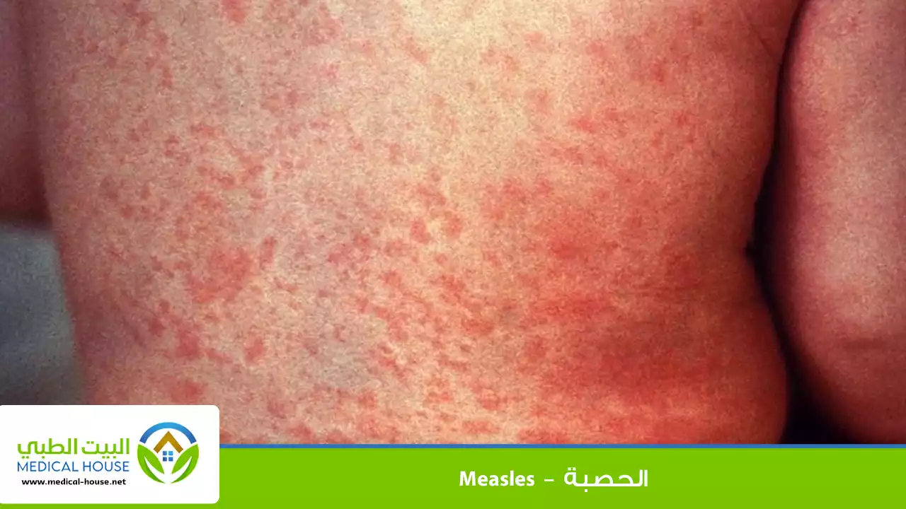 الحصبة