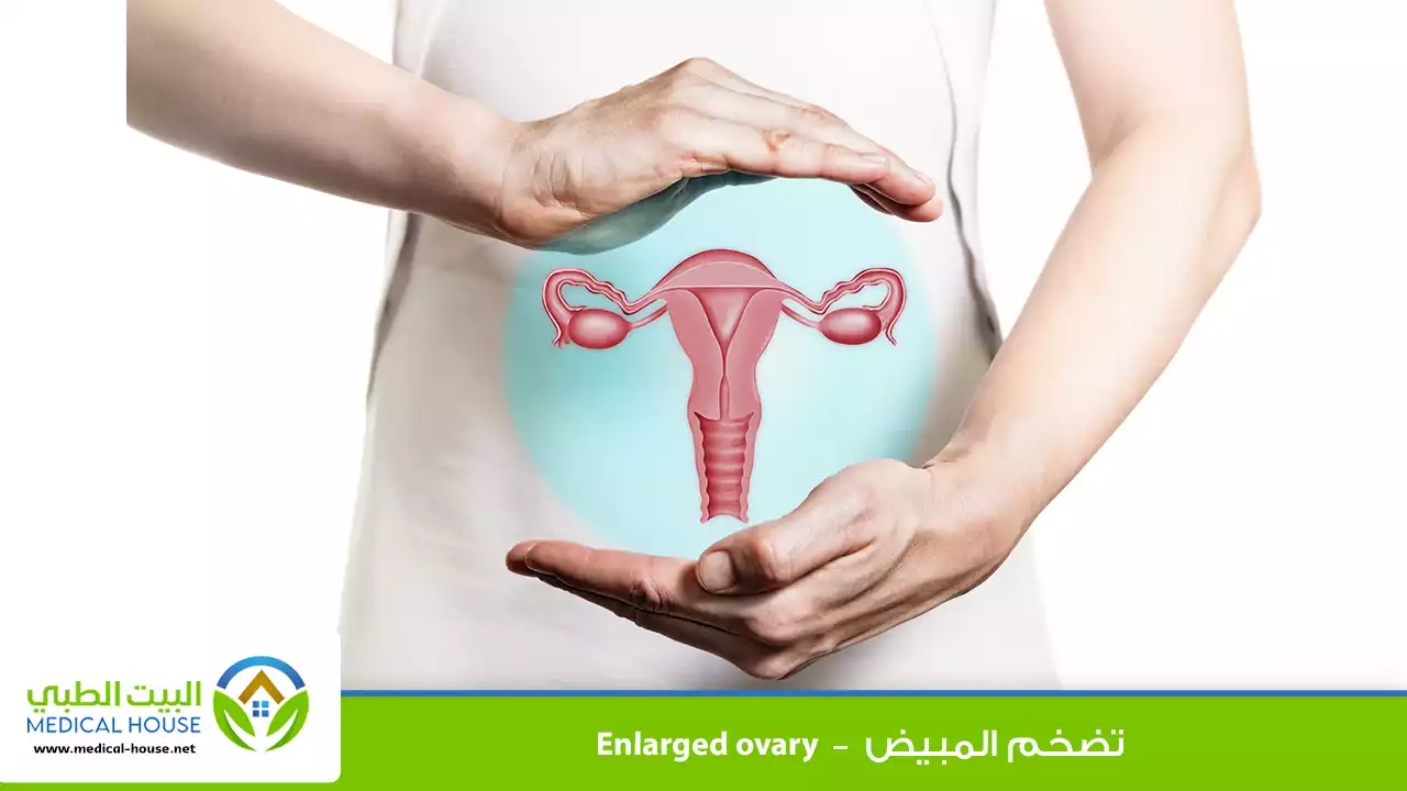 تضخم المبيض