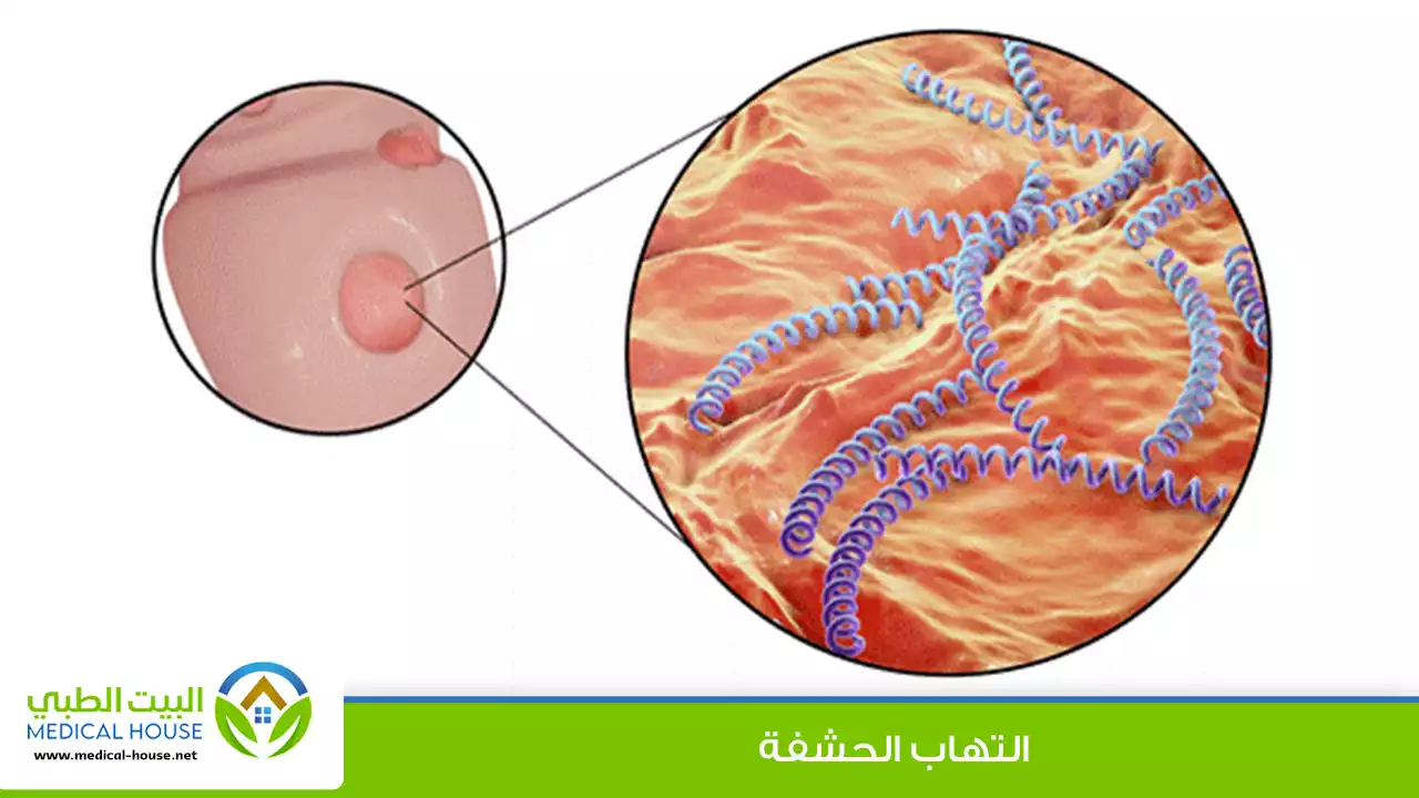 التهاب الحشفة