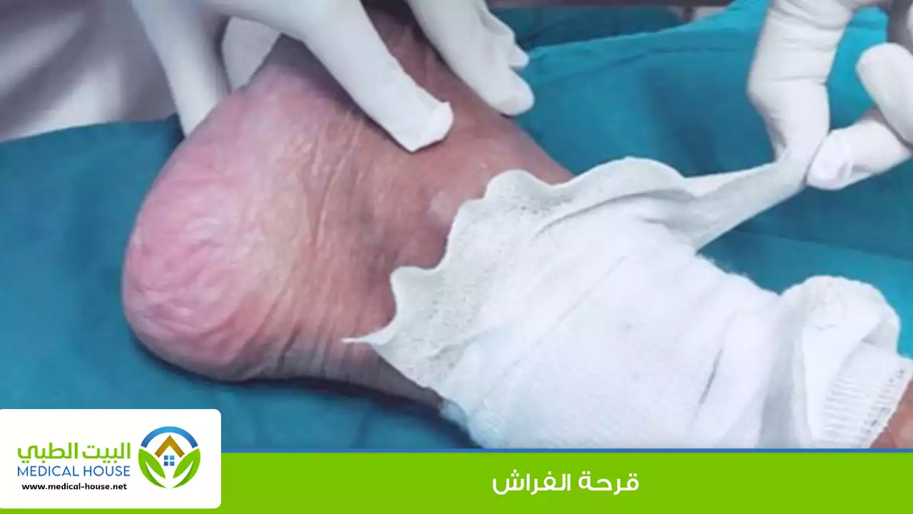 ماذا تعرف عن قرحة الفراش؟