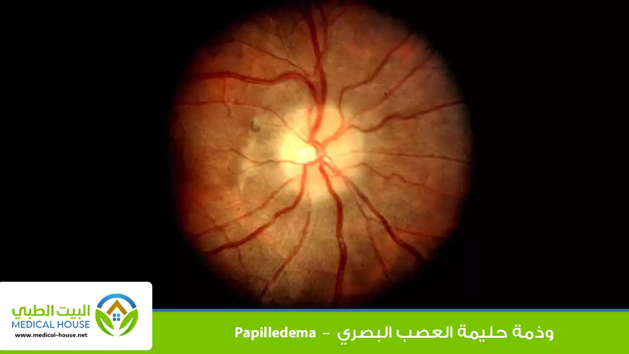 وذمة حليمة العصب البصري