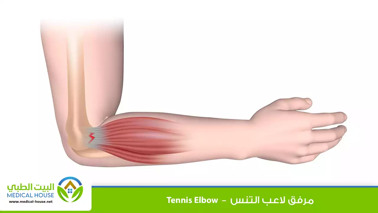 مرفق لاعب التنس