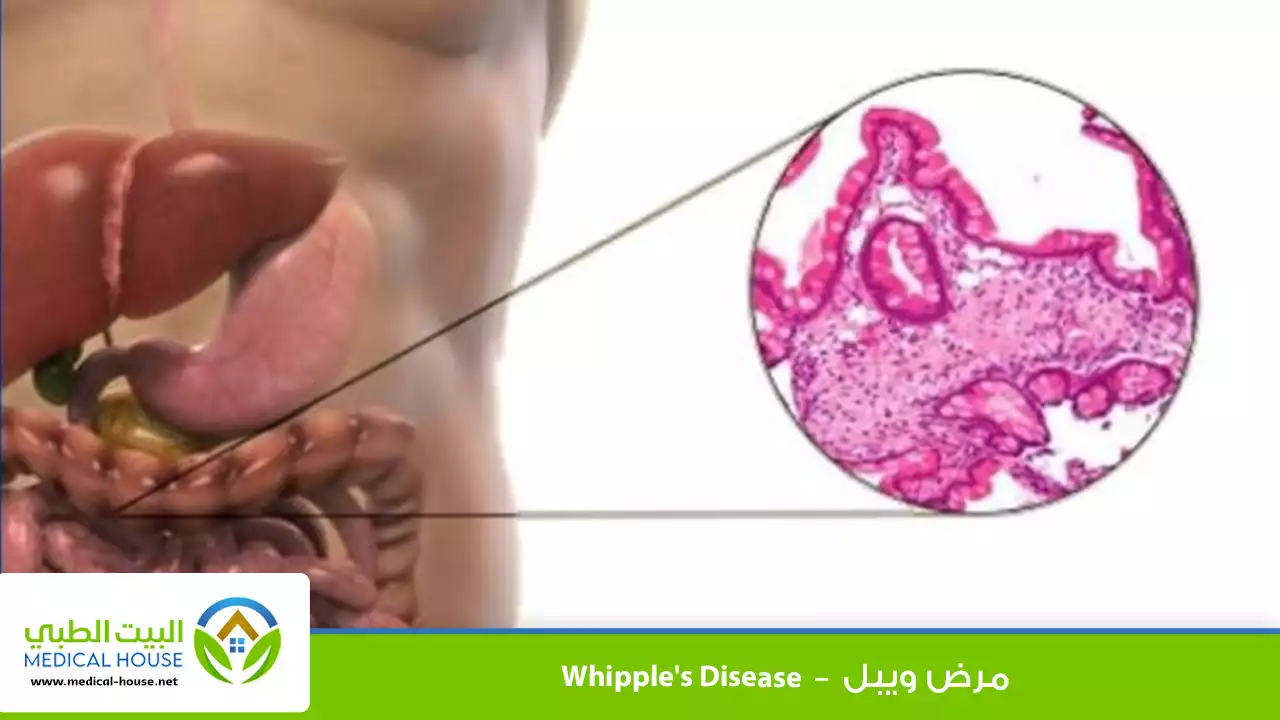 مرض ويبل