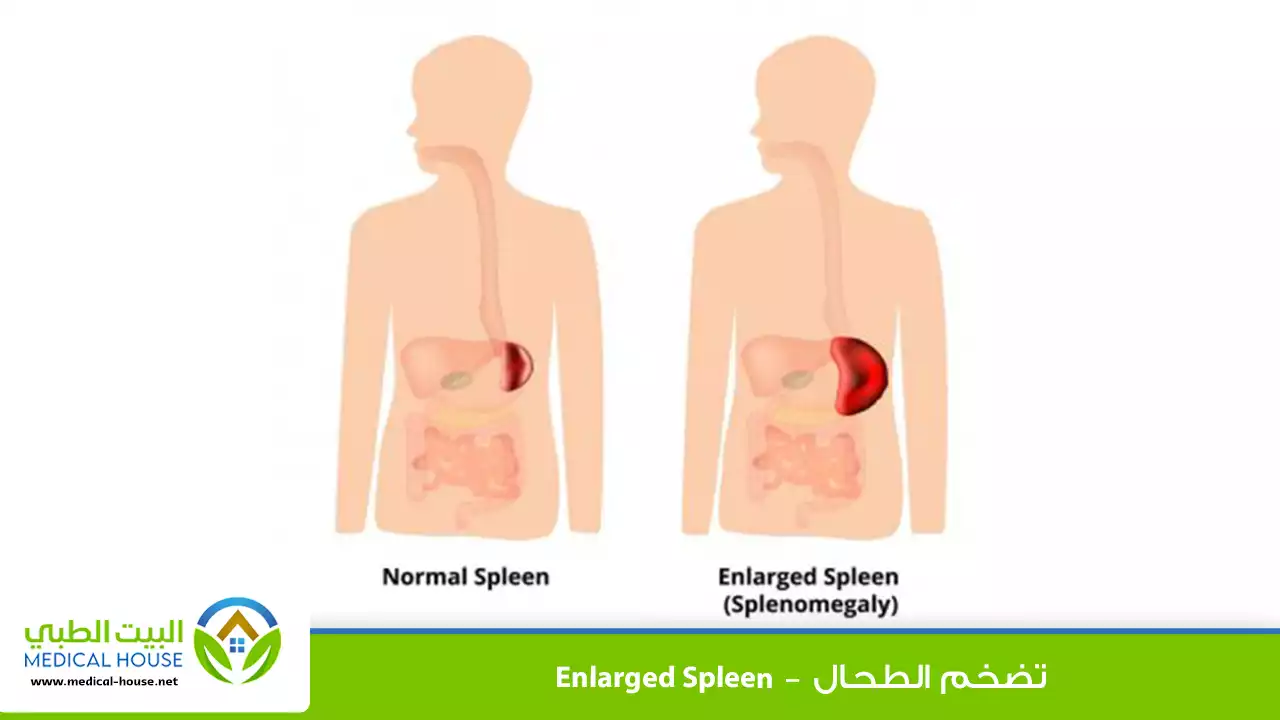 تضخم الطحال
