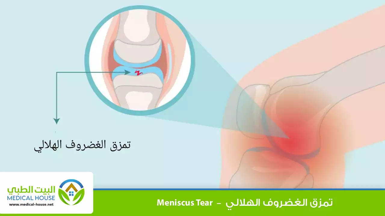تمزق الغضروف الهلالي