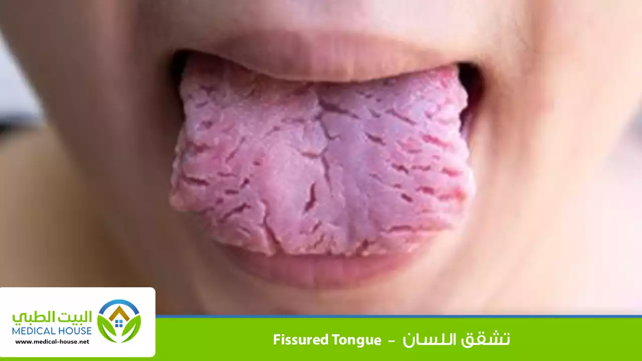تشقق اللسان