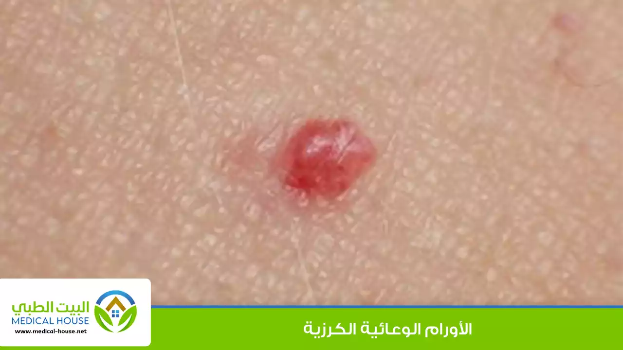 الأورام الوعائية الكرزية