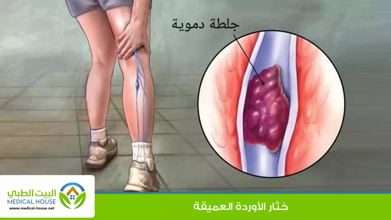 خثار الأورة العميقة