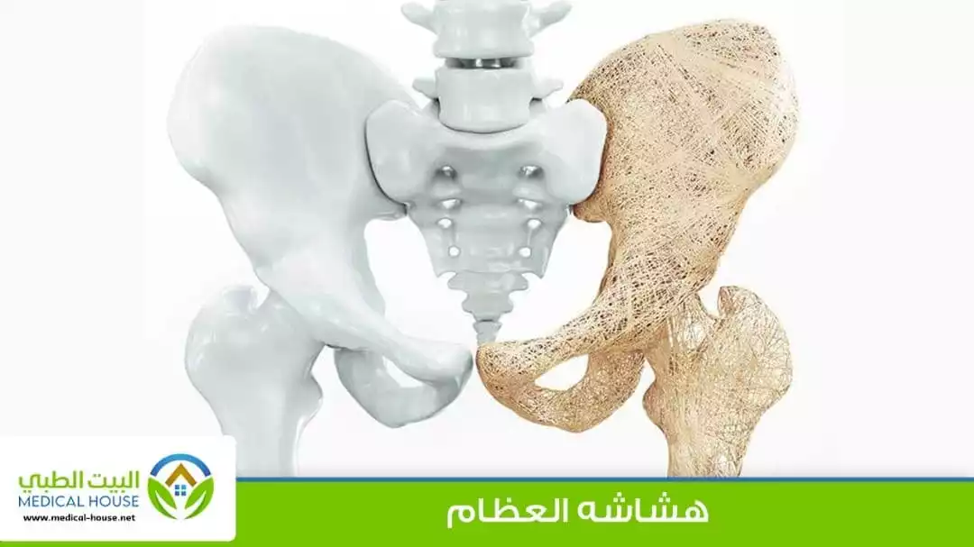 هشاشة العظام Osteoporosis