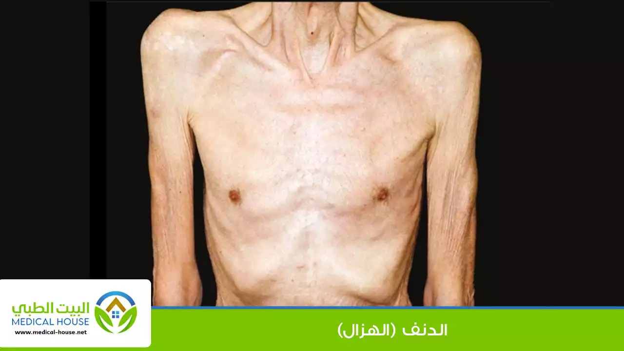 الدنف