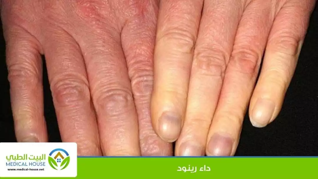 ماذا تعرف عن مرض رينود (Raynaud's Disease)