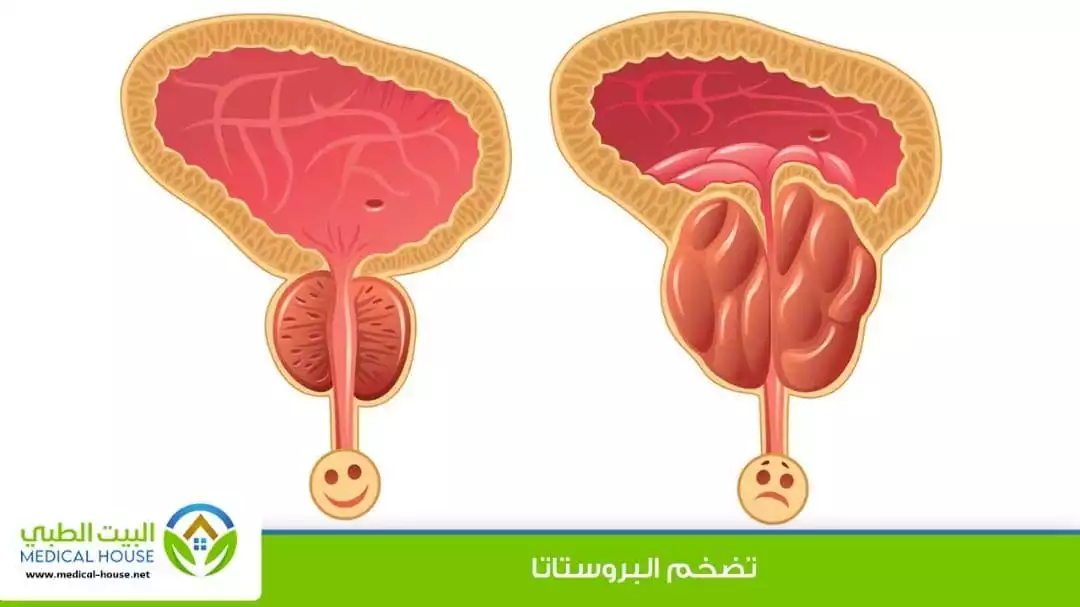 البروستاتا والانتصاب