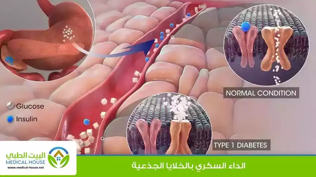 علاج الداء السكري بالخلايا الجذعية