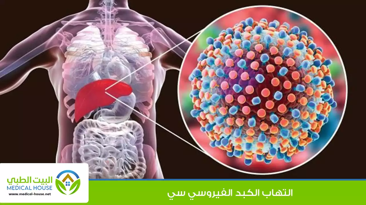 التهاب الكبد الفيروسي سي
