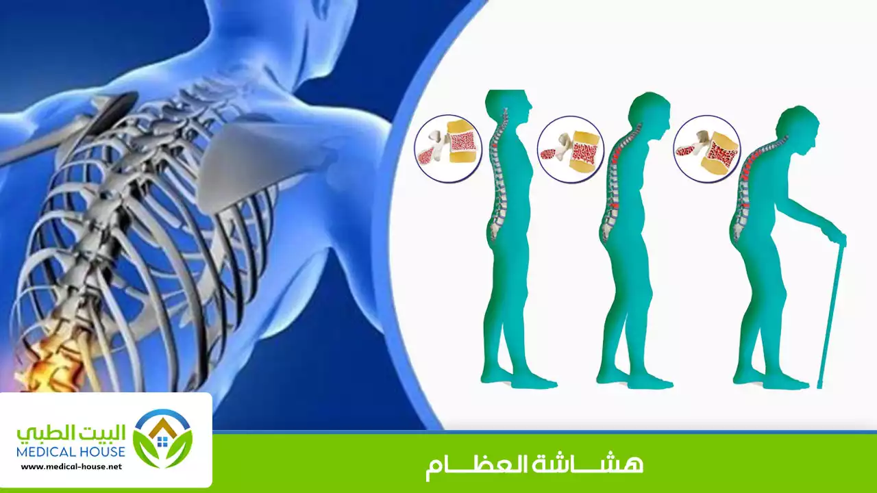 أسباب الإصابة بهشاشة العظام