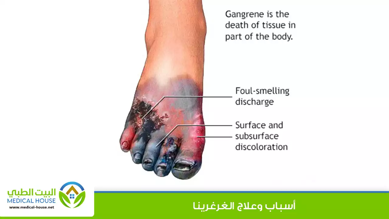أسباب وعلاج الغرغرينا